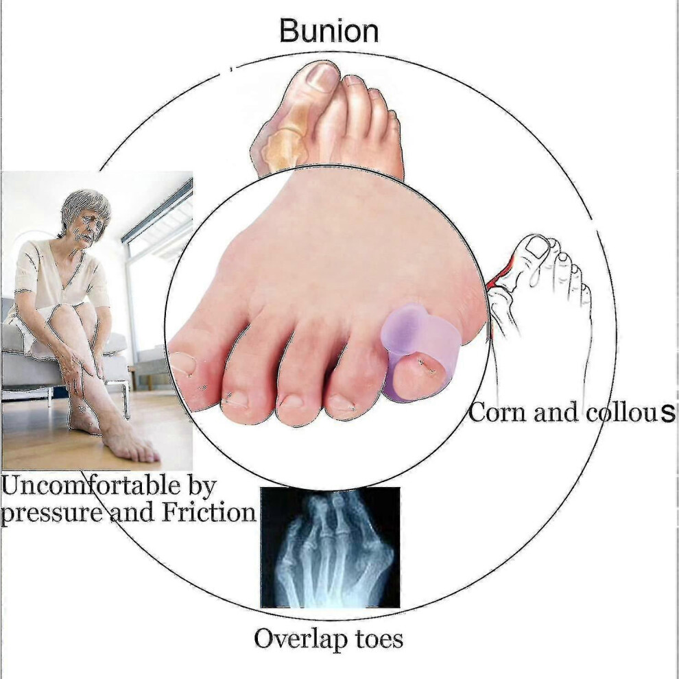 (As Show, One Size) 10-Pack Little Toe Splint, Gel Toe Separator, Little Toe Straightener Hammer Toe (Purple) 8H5-Po 4909775185263