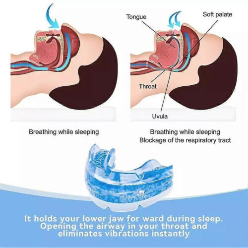 (Pink) Adjustable Snoring Device Mouth-Guard with Storage for Anti 2