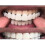 (Upper teeth) Upper/lower Comfort Fit Flex Whitening Denture Braces 3