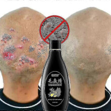 Scalp Hair Follicle Shampoo Antibacterial Anti-itching Mites Oil Control