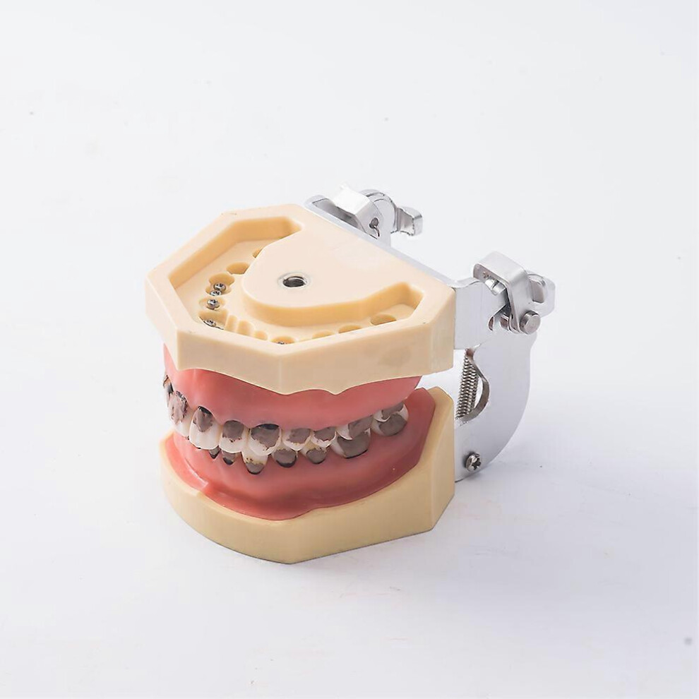 (As show, One size) Dental Calculus Model Dental Periodontal Disease Model Teeth Neural Repair Dental Implant Pathological Fitting Head Model