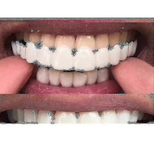 (Upper And Lower Teeth) Snap On Smile Dental Veneers Comfort Fit Flexible False Teeth Cover For Cosmetic Smile Enhancement Temporary Use -YT4