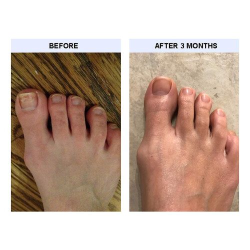 TIPS Toe Nail Conditioner 2 csomag 2