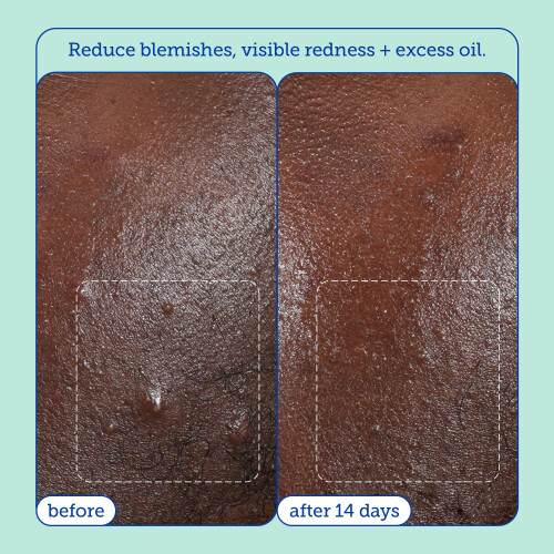 Skinfix Acne+ BHA Cleanser: Multi-Level Pore Resurfacing, 5 Fl Oz 2