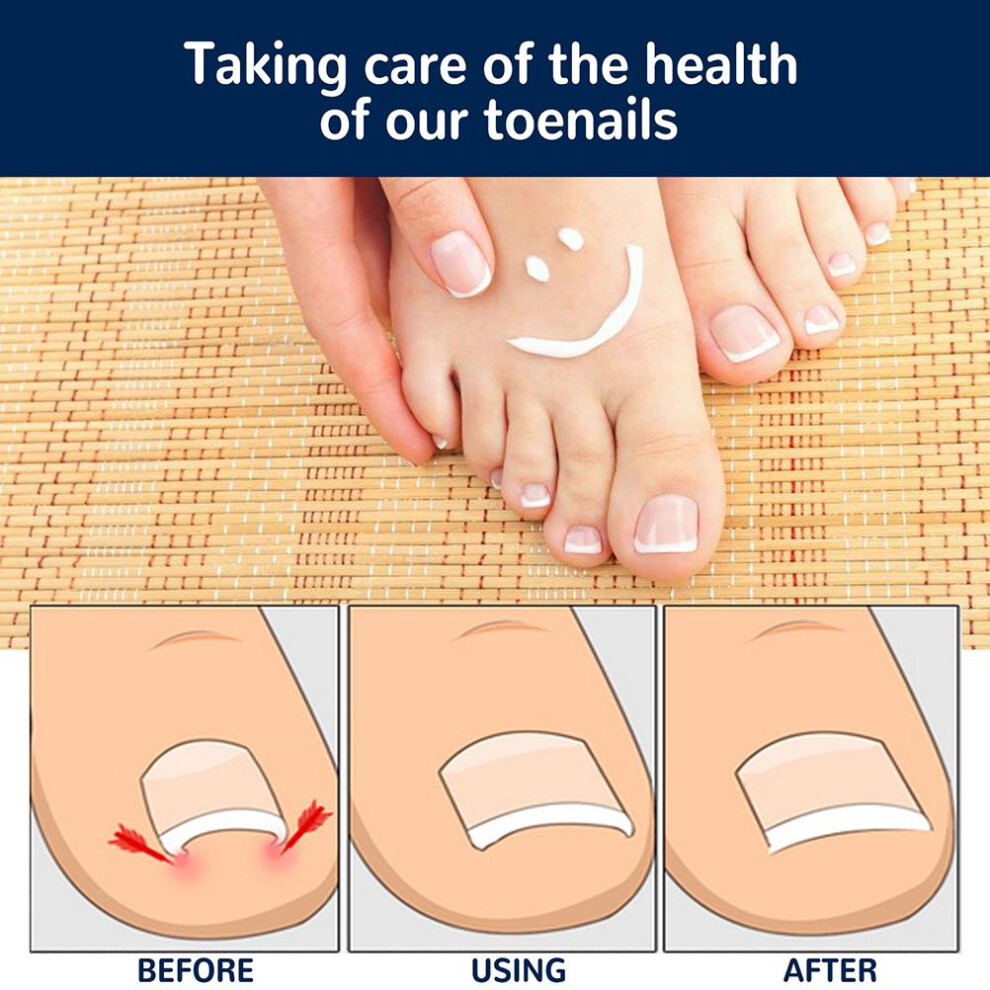 50 Pcs Ingrown Toenails Patch Sticker Toenail Patch Corrector Pedicure Tools Ingrown Toenail Correction Patch for Women Men