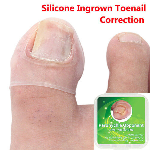2 pezzi di strumenti in silicone per unghia incarnita, alluce trasparente 1