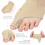Kit correcteur d'hallux valgus 20x15x4 135g 5