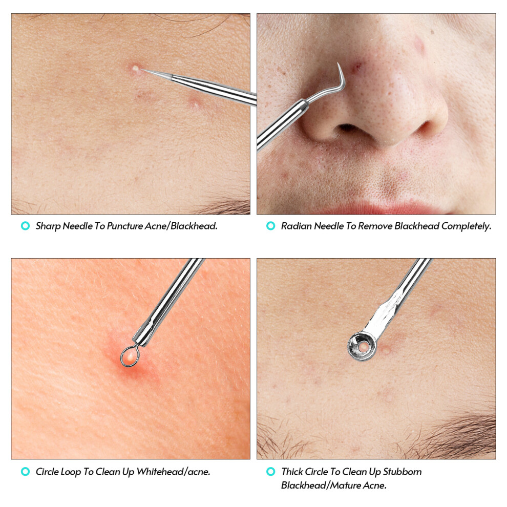 Blackhead Remover Pimple Popper Tool Kit for Pimple Blemish Comedone Acne Zit Whitehead Face Chin Noze Forehead Cheek Body