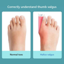 2 pièces Correcteur d'hallux valgus pour femmes, orteils, Bleu-Blanc, 34-43