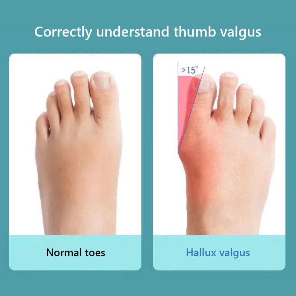 Blue/White 2Pcs Bunion Corrector For Women Universal Female Toe Splints Toe Separators For Overlapping Big Toe