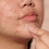 Buyfiy Hydrocolloïde Acne Spot Behandelingspleister 3