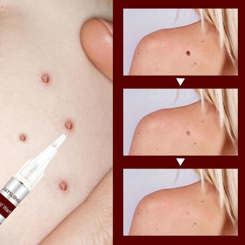 Mole remover, wart remover, hook remover, effective treatment, 3 ml 2