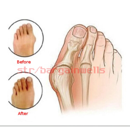 Hallux Big Toe Separator Straightener Bunion Valgus Splint Corrector Support 1