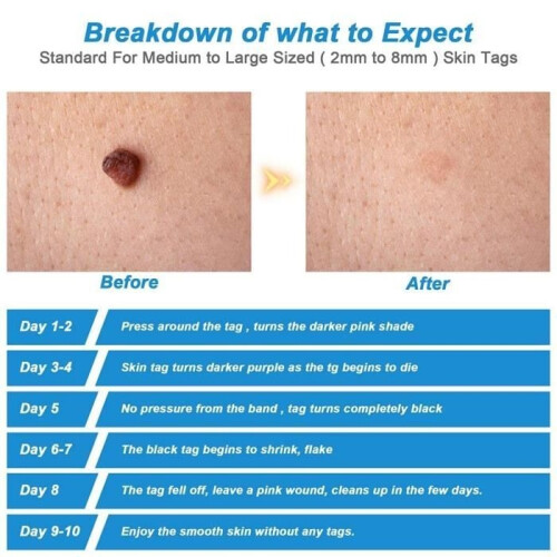 2-in-1 Automatic Micro Skin Tag Removal Kit, Automatic Skin Tag Removal Device 1