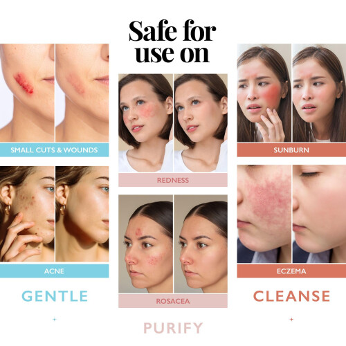 Spray d'acide hypochloreux pour le visage et la peau | Spray après perçage | 8 oz 2
