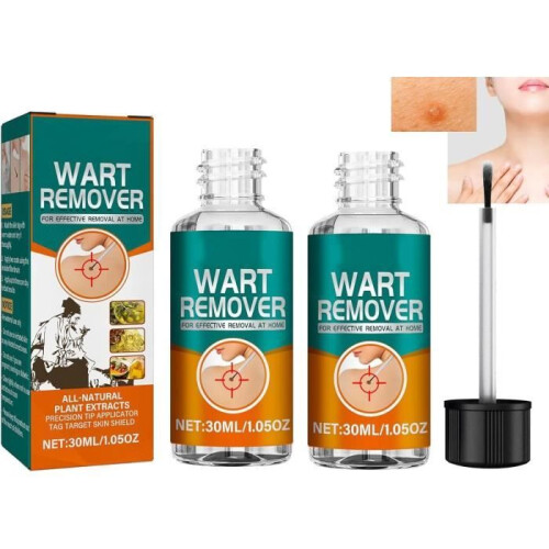 Skin tag removal fluid, skin tag treatment, wart removal
