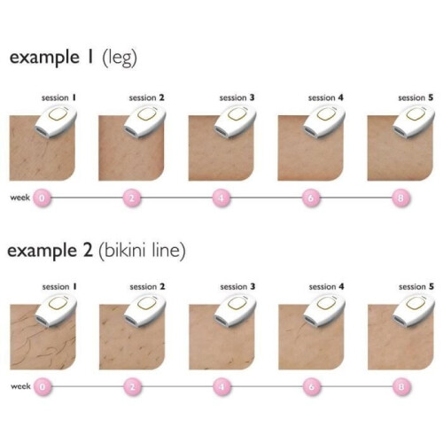 Kit per la depilazione laser - Bianco 2