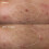 Dermalogica Dermalogica Deep Acne Liquid Patch, Onzichtbare Behandeling voor Puisten en Vlekken 4
