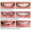 False Teeth Upper Lower Dental Veneers Dentures Tooth Cover Set [free Shipping]-hy 2