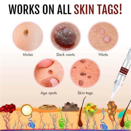 2X Tags And Mole Remover, Skin Tag Remover Liquid 1