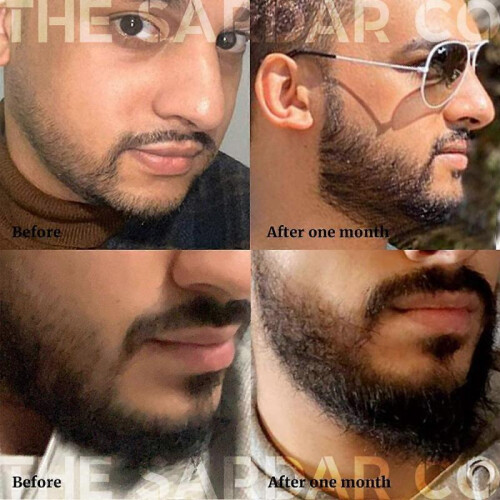 Derma Roller for Hair & Beard Growth - Microneedling 0.3mm 2