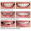 Upper Lower Dental Veneers Dentures - Snap On False Teeth for A Perfect Smile 2