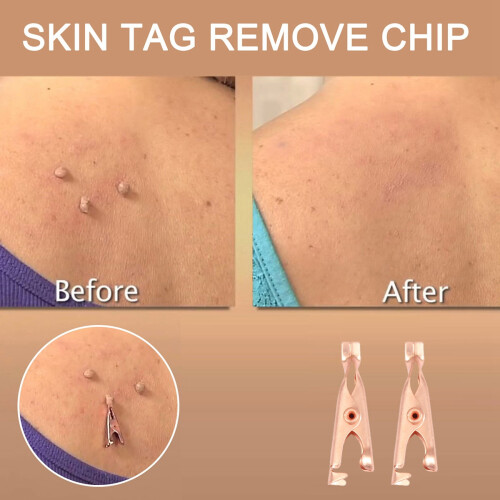 12Pcs Copper Skin Tag Remover Clips Wart Tag Extractor Copper Tag Out 1