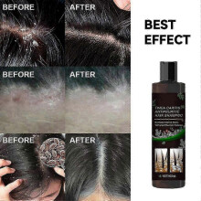 2025 Anti-itch Shampoo for Scalp Tinea Capitis To Dandruff And Relieve Itchy