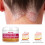 2X Skin Psoriasis Cream Dermatitis Eczematoid. 1