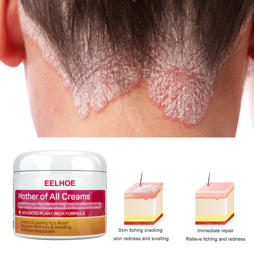2X Skin Psoriasis Cream Dermatitis Eczematoid.