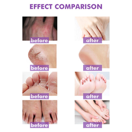 2X Skin Psoriasis Cream Dermatitis Eczematoid. 2