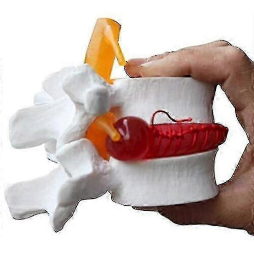 1pc Anatomical Lumbar Disc Herniation Lumbar Spine Model White Color