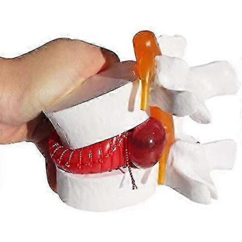 1pc Anatomical Lumbar Disc Herniation Lumbar Spine Model White Color 1