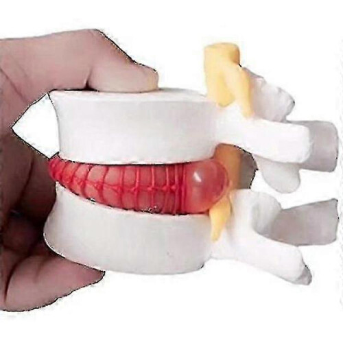 1pc Anatomical Lumbar Disc Herniation Lumbar Spine Model White Color 2