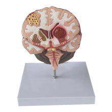 Modello di malattia del cervello umano - Patologia Emorragia del tronco encefalico Insegnamento medico Anatomia