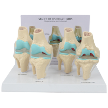 Kniekit Artrose Anatomie Model met Educatieve Sleutelkaart 4-Stages Orthopedische Leermiddelen