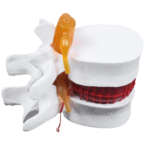 Human Anatomy Skeleton Spine Lumbar Disc Herniation Teaching Model 1