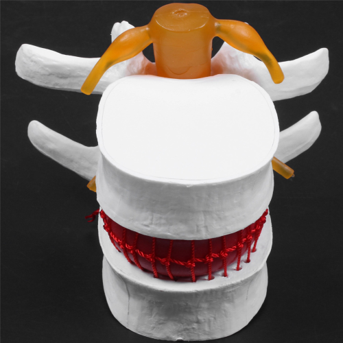 Human Anatomy Skeleton Spine Lumbar Disc Herniation Teaching Model 2