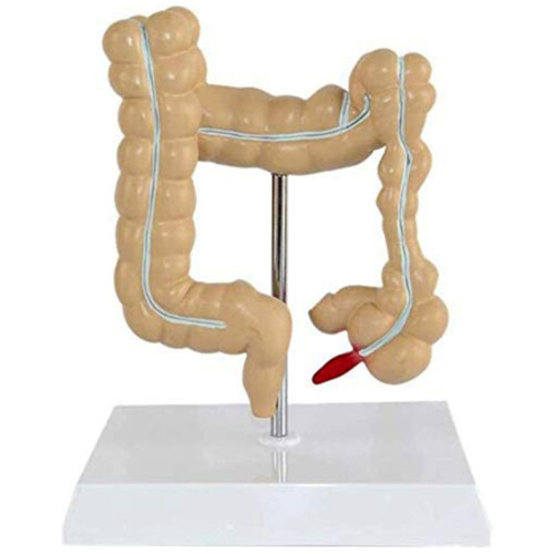 Pathologisch colorectaal model dikke darm gastro-intestinaal anatomisch 1