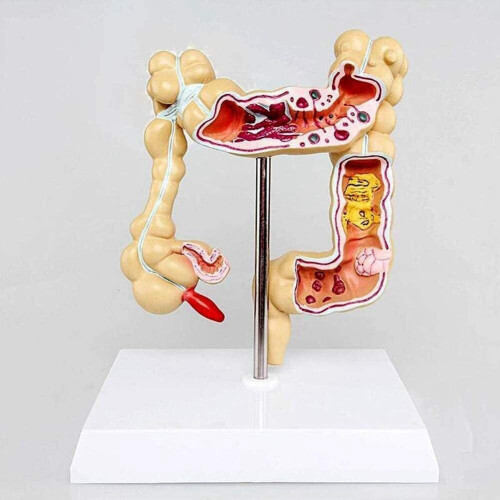 Pathologisch colorectaal model dikke darm gastro-intestinaal anatomisch 2