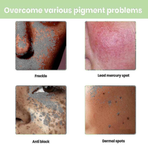 Lightening Cream Lightening Melasma, -b 1