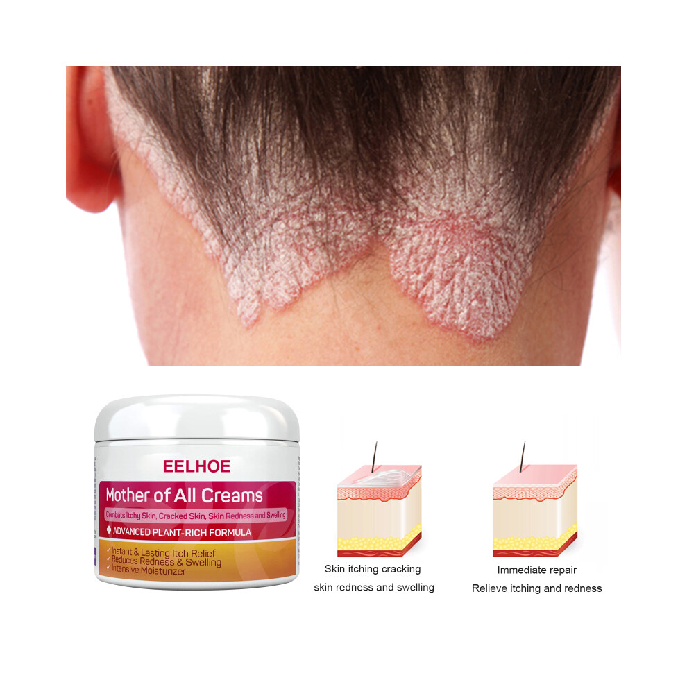 3PCS Skin Psoriasis Cream Dermatitis Eczematoid Eczema Ointment Treatment-image-OPC-PJCBTFH-NEW