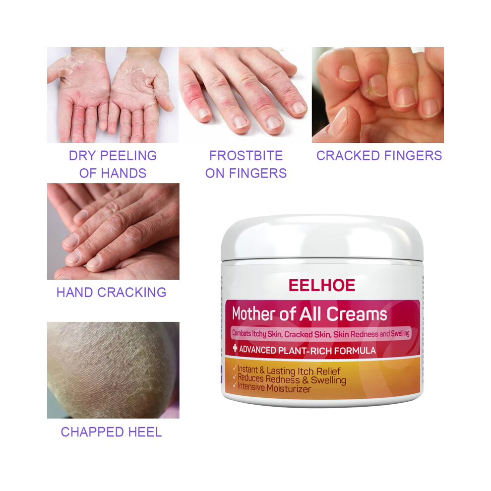 2PCS Skin Psoriasis Cream Dermatitis Eczematoid Eczema Ointment Treatment-image-OPC-PJCBTFJ-NEW