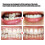 Clear Orthodontic Retainer Brace - Corrects Crowded Teeth for All Ages 7