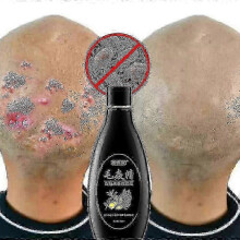 Scalp Hair Follicle Shampoo Antibacterial Anti-itching Mites Oil Control Psoriasis And Scalp Cleansing Shampoo Skincare Product Hk