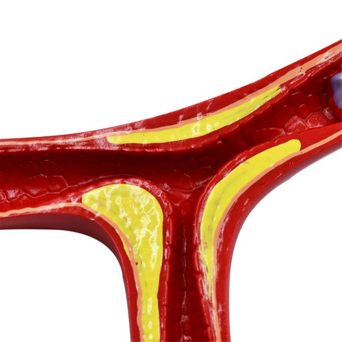 Human Atherosclerosis Cardiovascular Model Vascula 2