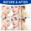 Skin Tag Removal Kit Painless Pen Easy Device Remo 6