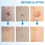 Skin Tag Removal Kit Painless Pen Easy Device Remo 3