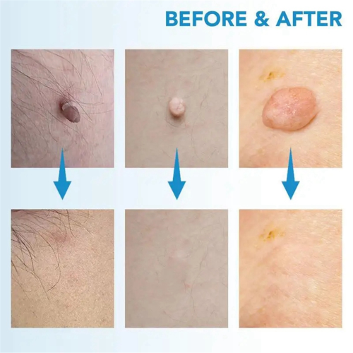 Skin Tag Removal Kit Painless Pen Easy Device Remo 2