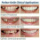 4 Pcs Snap On Smile Teeth Veneers Whitening Cosmetic Denture, Tooth Cover Set (hs) 4